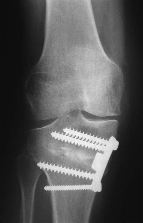 Osteotomy For Medial Compartment Arthritis Of The Knee Using A Closing