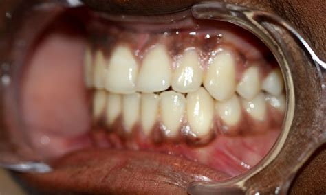 What Causes Black Gums Directorio Odontológico
