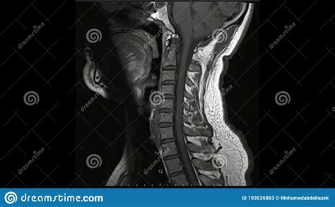 Magnetic Resonance Images Of Cervical Spine Sagittal T1 Weighted Images
