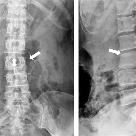 Anteroposterior A And Lateral B Radiographs Of The Lumbar Spine At