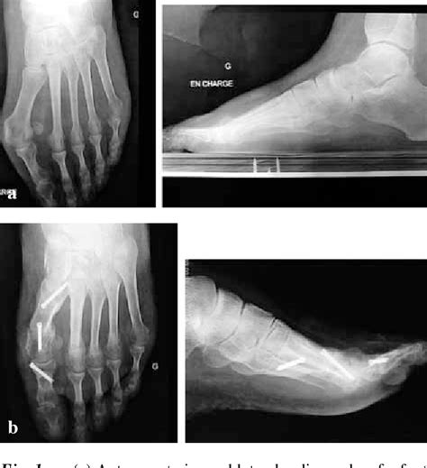 Pdf Percutaneous Double Metatarsal Osteotomy For Correction Of Severe Hallux Valgus Deformity