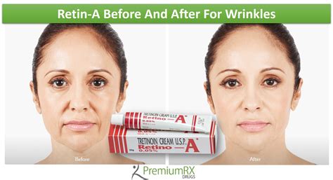 Retin A Before And After For Wrinkles Premiumrx Online Pharmacy