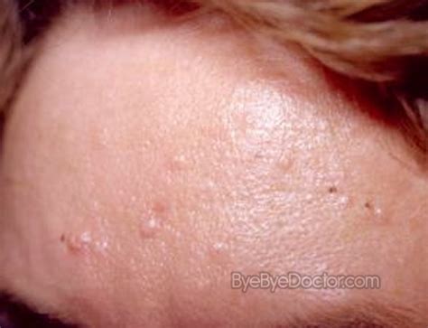 Sebaceous Hyperplasia Treatment Removal Pictures Causes Prevention