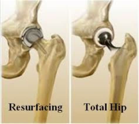 Hip Resurfacing Sudhir Rao Knee Hip And Shoulder Surgeon