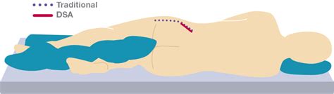 Direct Superior Total Hip Replacement Pomona Minimal Invasive Hip