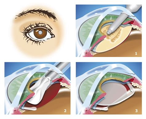 Comment D Terminer La Puissance De Votre Implant De Chirurgie De Cataracte Docteur Gonzalvez