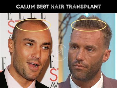 Calum Best Hair Transplant Hair Loss Technical Analysis