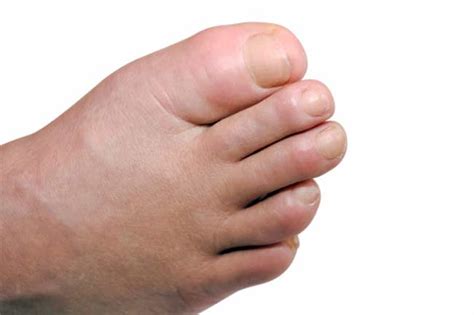 7 Tips To Treat Swollen Feet In Diabetics