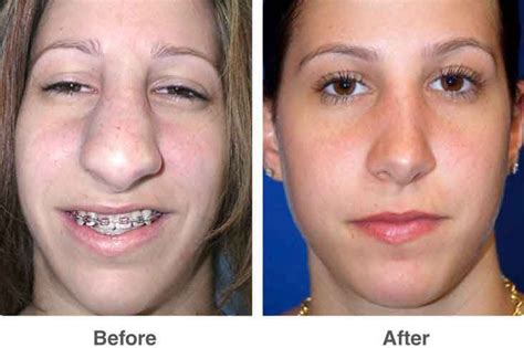 plastic surgery on nose 10 liposuction before and after plastic surgery rhinoplasty nose