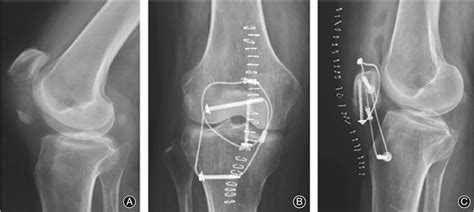 Comparison Of A Novel Tension Band And Patellotibial Tubercle Cerclage