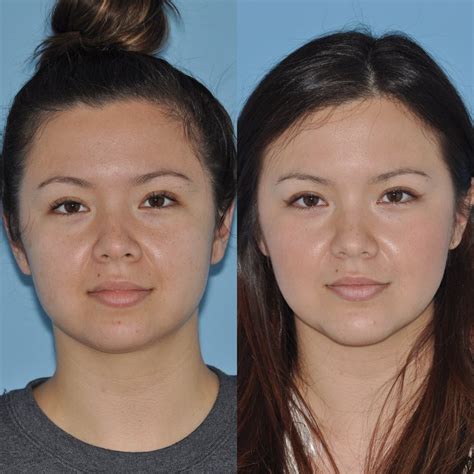 Patient 31709227 Buccal Fat Excision Before And After Photos Bloom