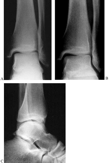 Ankle Fractures And Dislocations Including Pylon Fractures Teachme