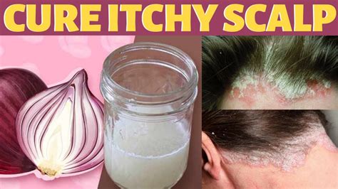 How To Treat Itchy Scalp And Dandruff Naturally At Home Without Washing