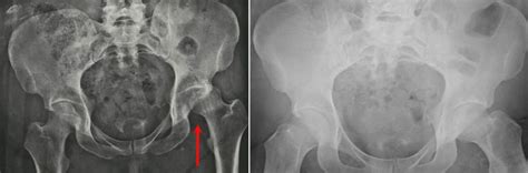 Hip Dislocation Orthoinfo Aaos