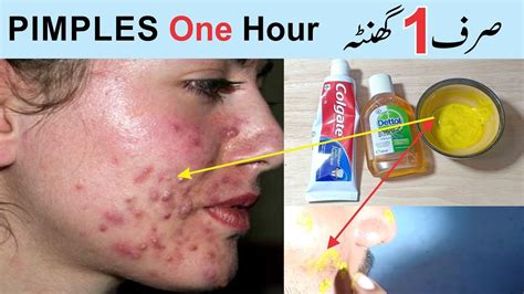 how to remove pimples overnight home remedy pimple remove in one hour youtube