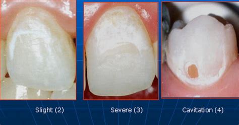 White Spot Lesions During Orthodontic Treatment Mechanisms And