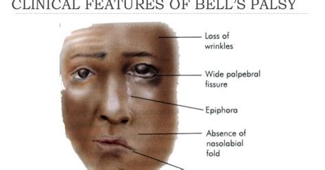 You will be feeling that half of your face appears to droop. Bell's palsy| definition, causes, symptoms, signs and ...