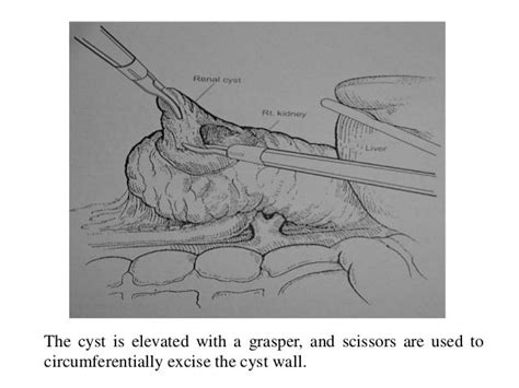 Laparoscopic Kidney Surg