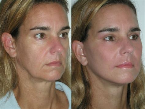 How To Look Younger With Facial Toning And Exercises Utilize Face