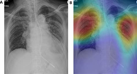Chest Radiograph Based Artificial Intelligence Predictive Model For