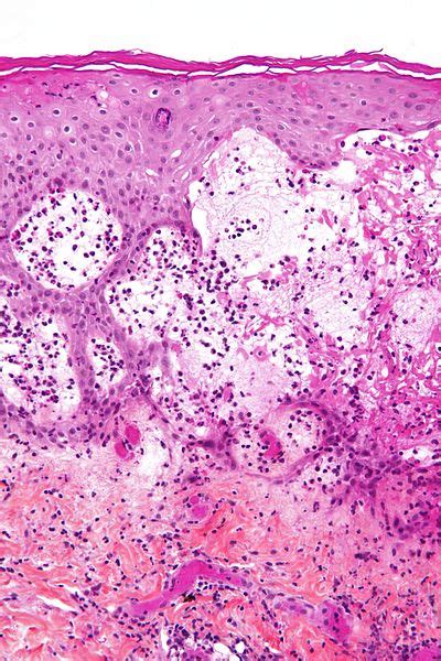 Herpes Gestationis Pemphigoid Gestationis Obstetrics Medbullets