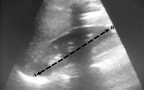Longitudinal Ultrasound Scan Of The Right Kidney Showing Measurement Of