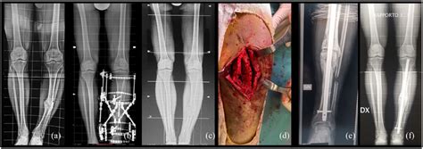 A Clinical Case Of A 38 Years Old Male With A Tibial Varus Malunion A