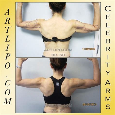 Revolutionary Celebrity Arms Liposuction Celebrityarmsliposuction