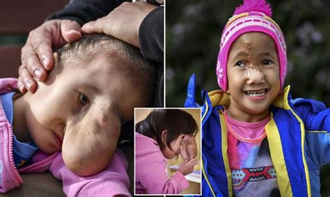 Little Girl With A Rare Facial Deformity Flown To Australia For Life