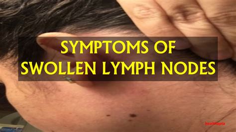 Symptoms Of Swollen Lymph Nodes Youtube
