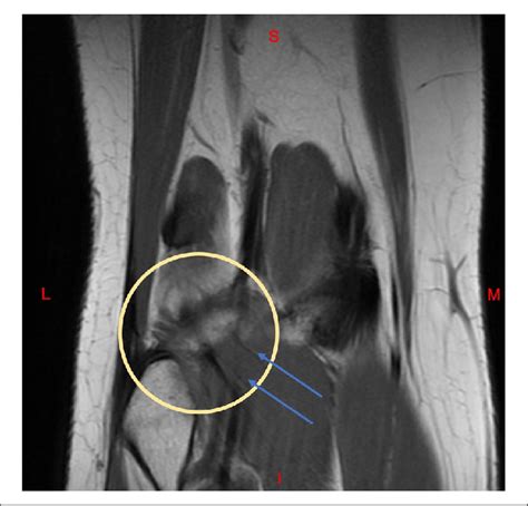 Coronal Mri Of The Right Knee The Distal Popliteal Muscle Is