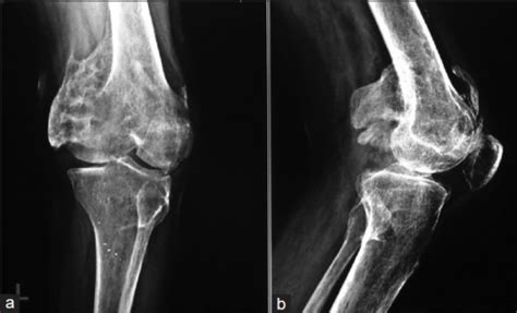 X Ray Of Left Knee Showing Heterotopic Ossification Aro Open I