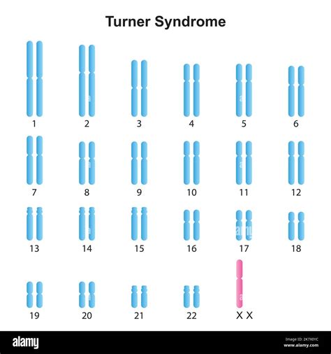 Turner Syndrome Karyotype Banque D Images D Tour Es Alamy