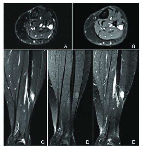Contrast Enhanced Mri Of The Left Leg Axial Images T2 Weighted Image