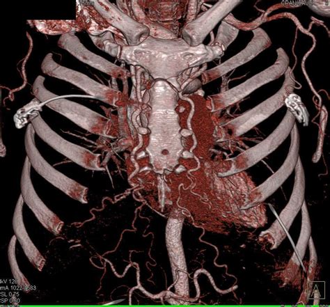 Coarctation Of The Aorta With Dilated Internal Mammary Arteries And