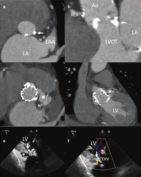 Aortic Annulus Rupture In An 88 Year Old Patient Receiving A