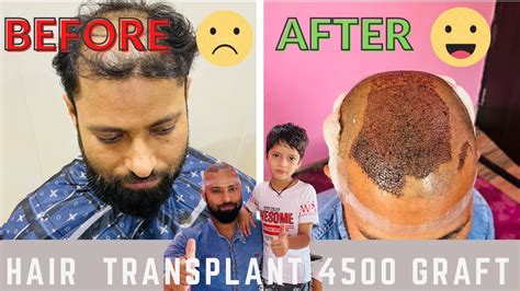 Live Hair Transplant Surgery Hair Transplant Karne Me Kitna Time