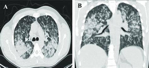 Chest Ct Scan Revealed Parenchymal Consolidation And Soft Tissue