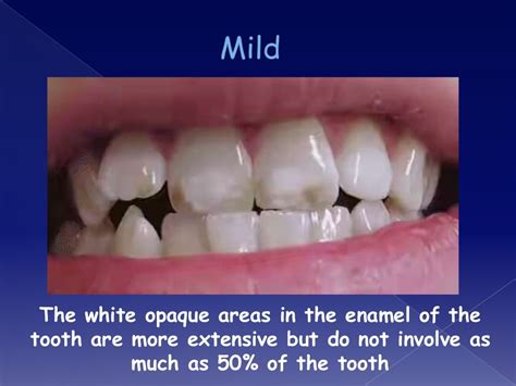 Overview On Dental Fluorosis