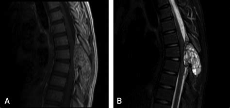 Spinal Aneurysmal Bone Cyst Causing Spinal Cord Compression Mayo