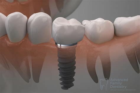 Single Tooth Dental Implants In Reston Best Options And Cost