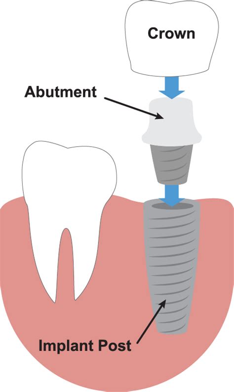 Trust Experience Dental Implants Can Restore Your Smile
