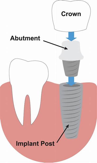 Dental Implants Illustration Denture Dentistry Teeth Help