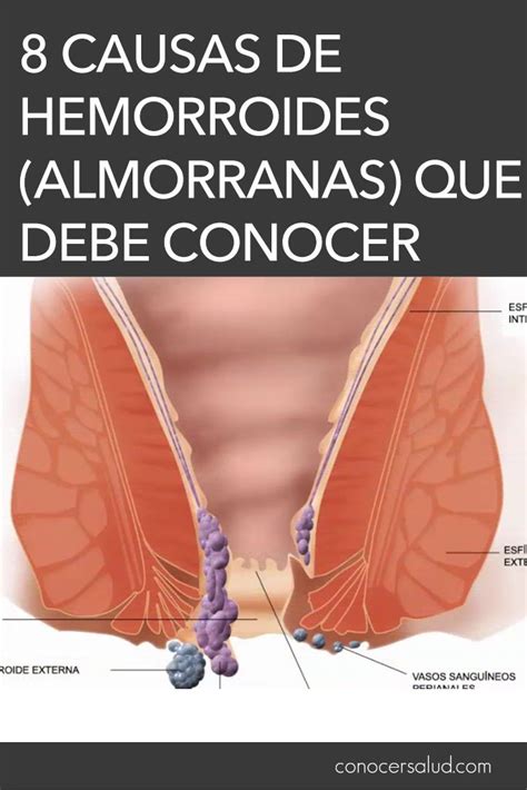 Causas De Hemorroides Almorranas Que Debe Conocer Salud Places 74028
