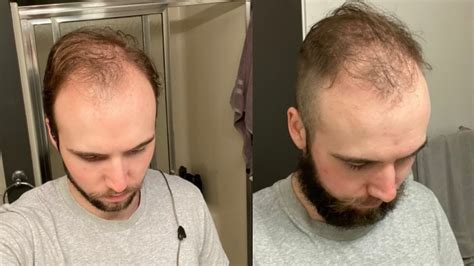 Balding At 20 Why I’m Shaving My Head Bald Youtube