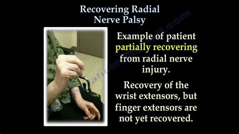 Radial Nerve Palsy Recovering Part Ii Everything You Need To Know