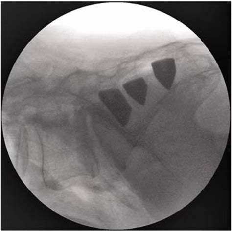 Sacroiliac Joint Arthrodesis Mis Technique With Titanium Implants