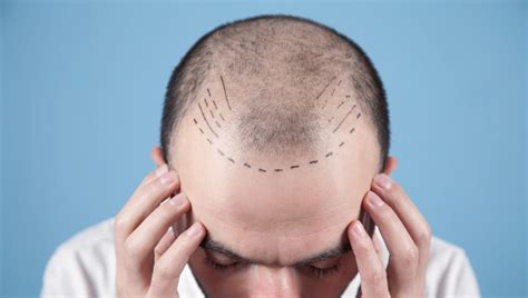 Hair Transplant The New Male ‘must Have Procedure Medical Travel Market