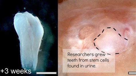 Researchers Grow Teeth Like Structure Using Stem Cells From Urine