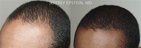 Hair Transplants For Men Photos Miami FL Patient38625